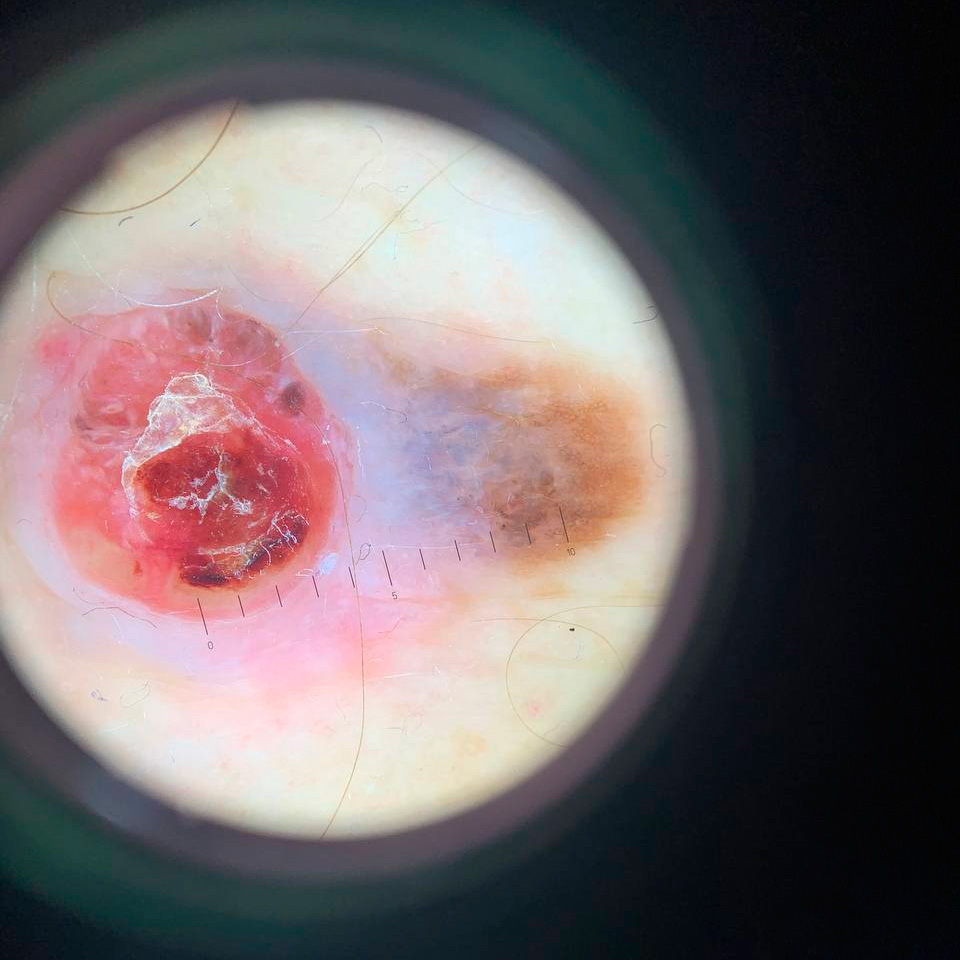 Melanoscope